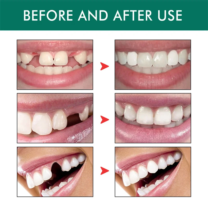 OEM Temporary tooth repair kit Glue gap fillers for broken teeth Missing tooth repair kit Homemade glue dentures