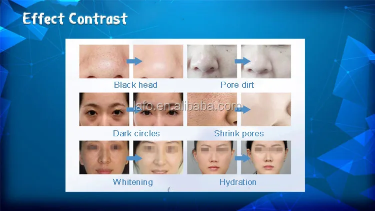 personal skin care analysis machine skin rejuvenation antiwrinkles rf equipment facial microdermabrasion machine for lifting