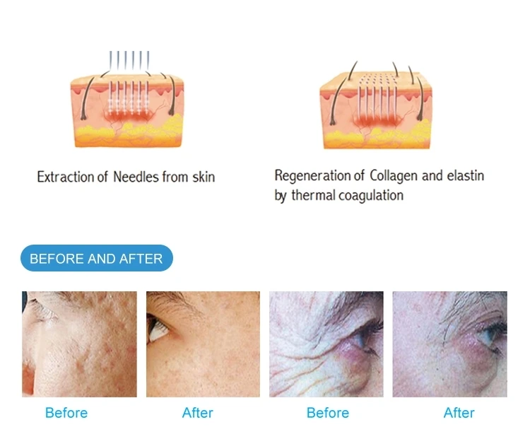 
Gold Microneedle Scarlet Fractional Secret RF Needle Skin Rejuvenation Tightening Vivace Radio Frequency Microneedling Machine 