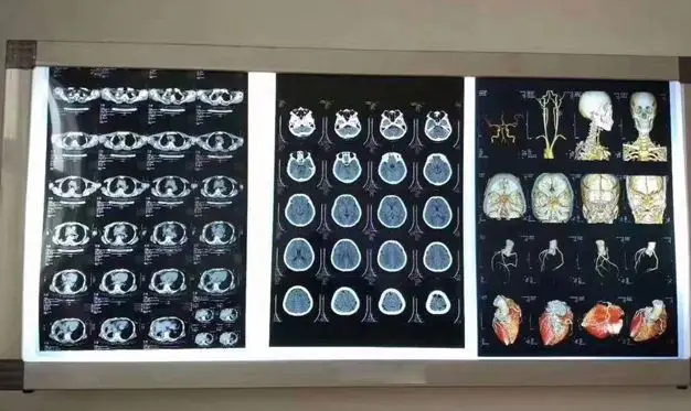 11X14inch High definition medical white film that can be viewed directly No need for film viewing lights  for PANTUM Printer