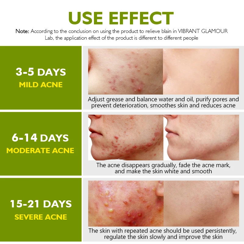 OEM/ODM VIBRANT GLAMOUR Herbal Acne Treatment Cream Oil Control Brighten Nourish Whitening Shrink Pores Remove Scars Marks