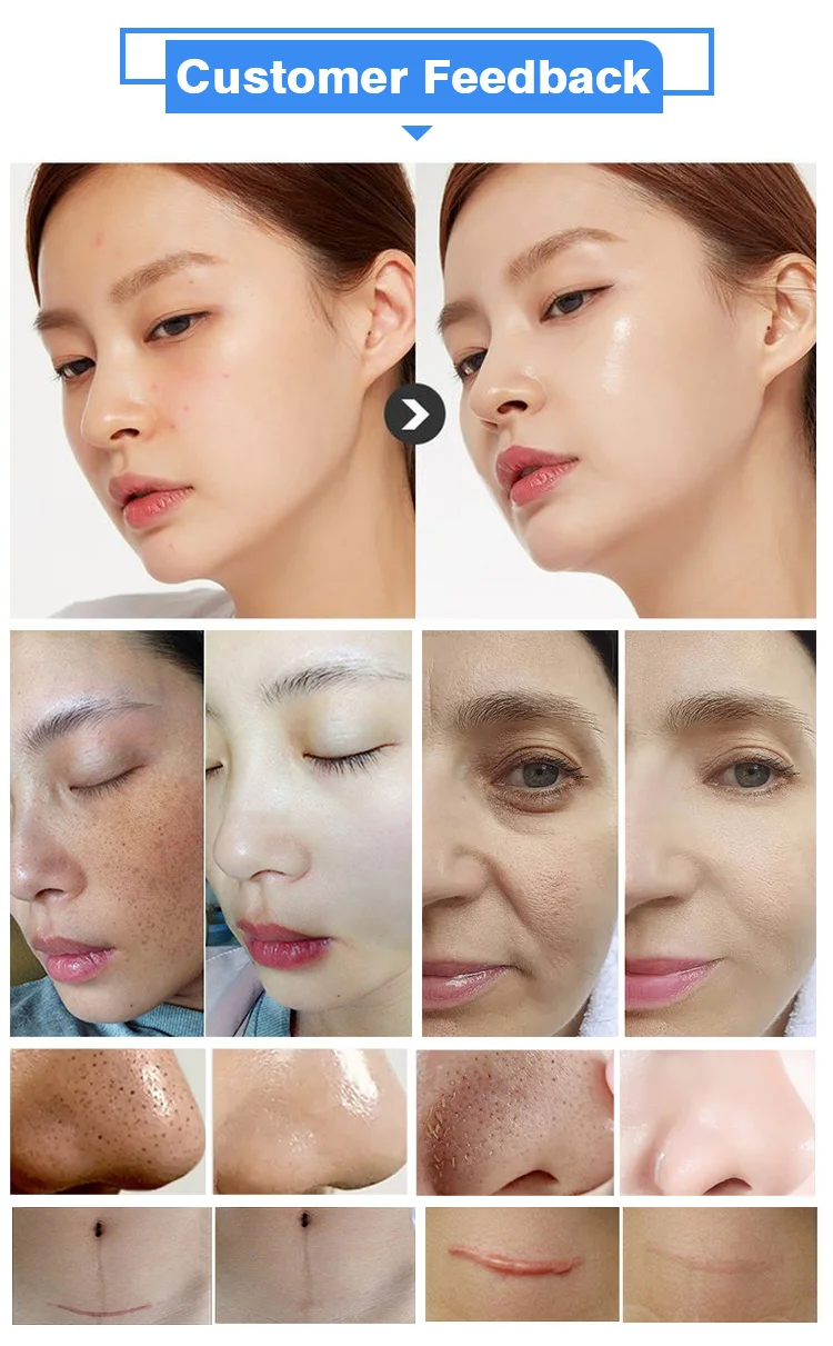 Hydra Beauty Water Oxygen Whitening Peel Microdermabrasion Hydro Dermabrasion Face Machine