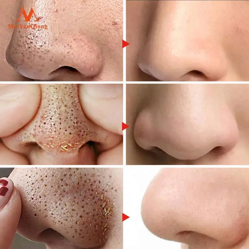 Volcanic Soil Facial Mask Acne Remove Blackhead Mite Propolis Face Treatment Repair Whitening Cream Skin Care Moisturizing