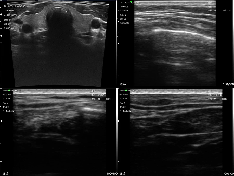 Super Width Linear Probe Type Wireless Mini Ultrasound Scanner