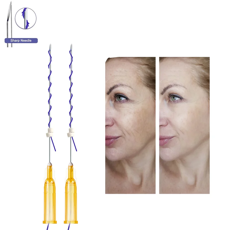 Korea quality skin face lifting barbed small 25G 60mm screw cog mini hilos pdo thread for eye brown lifting