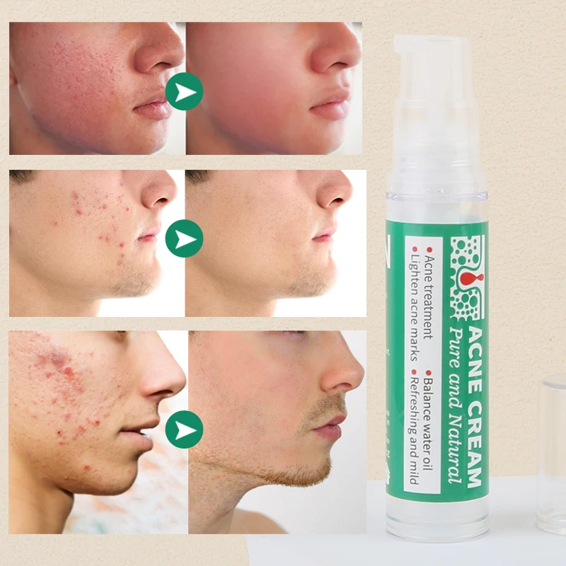 Custom Logo Skin Care Anti Aging Wrinkles Moisturiser Hyaluronic Acid Facial Firming Moisturising Aloe Vera Gel Anti Acne Cream