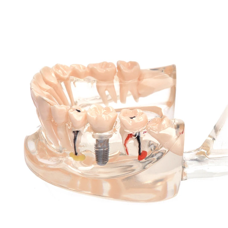 High quality lab typodont dental model practice dental implant model