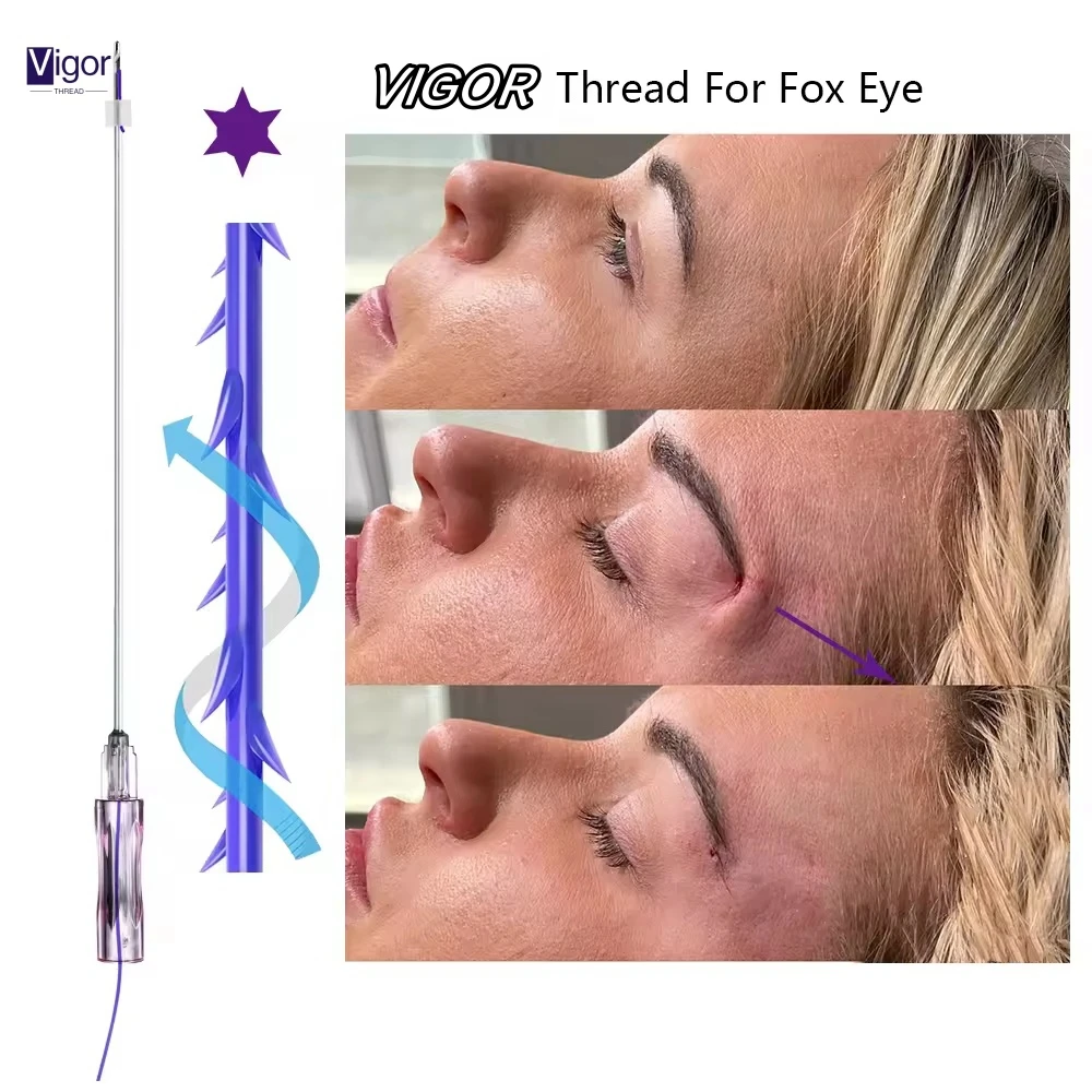 Vigor koreabulk pdo threads tension threads cog molding tension threads face lifting cog pdo 6d 18g 100mm minerva