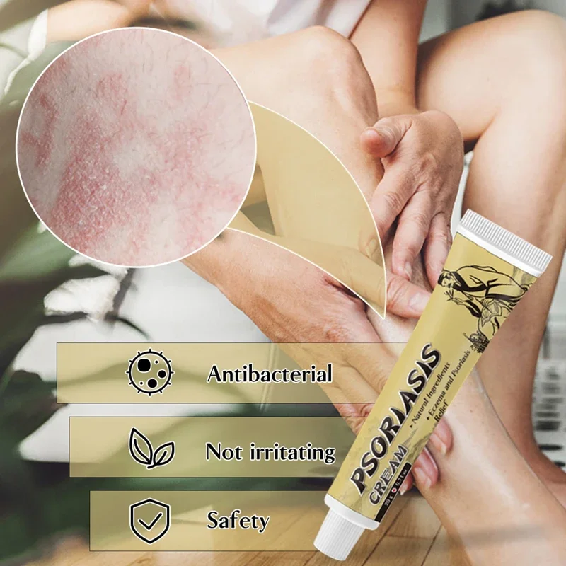 hot selling fungal infection skin psoriasis cream dermatitis eczema ointment treatment psoriasis cream skin cream