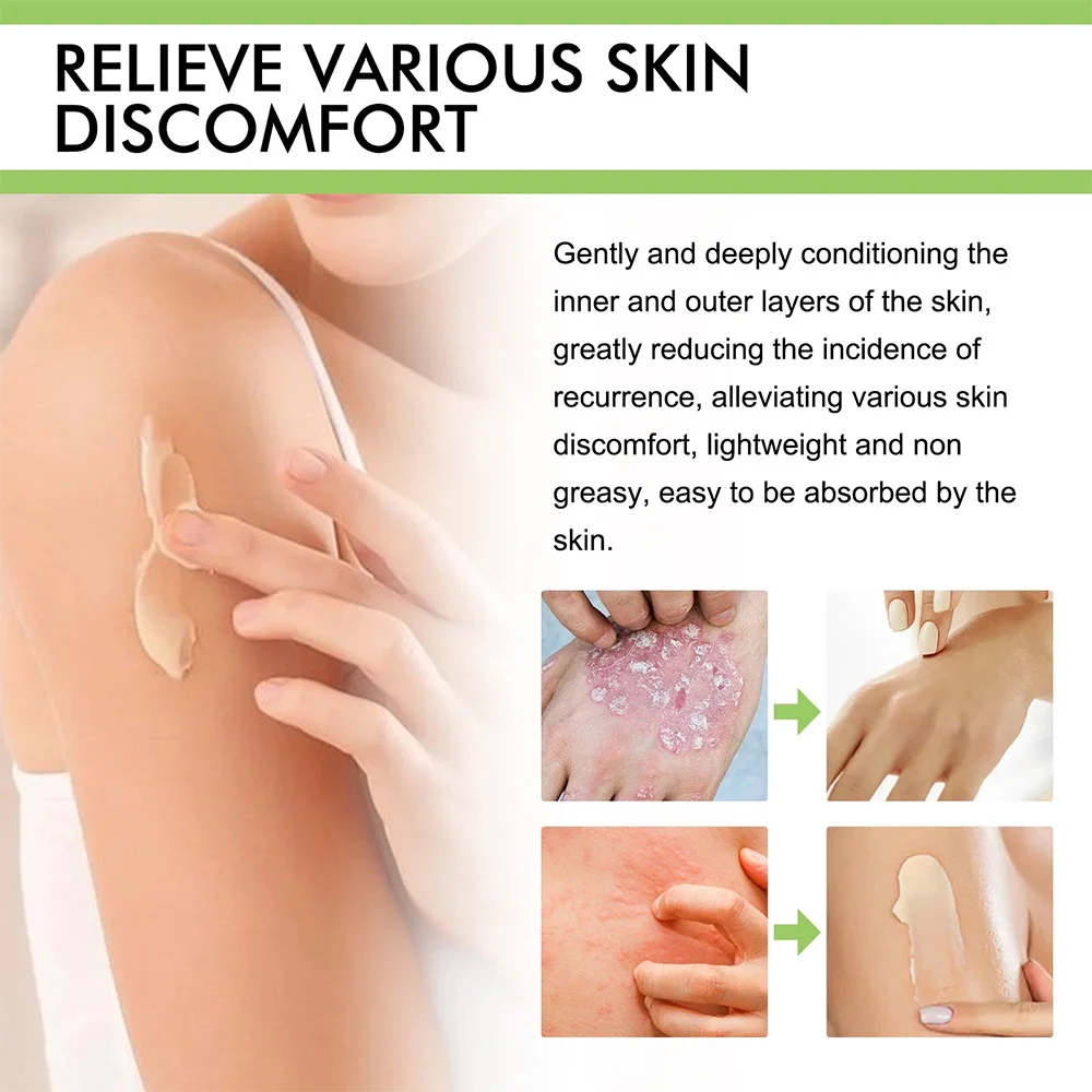 ZB Psoriasis Cream Chinese Herbal Anti-fungel Ointment Dermatitis Eczematoid Eczema Anti-itch Balm 50g