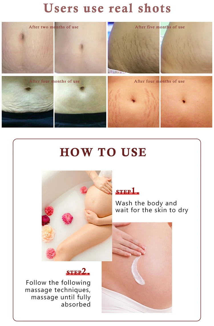 New Arrival Skin Care Pregnancy Slack Anti Stretchmark Scar Repair Body Stretch Marks Removal Cream for Selling