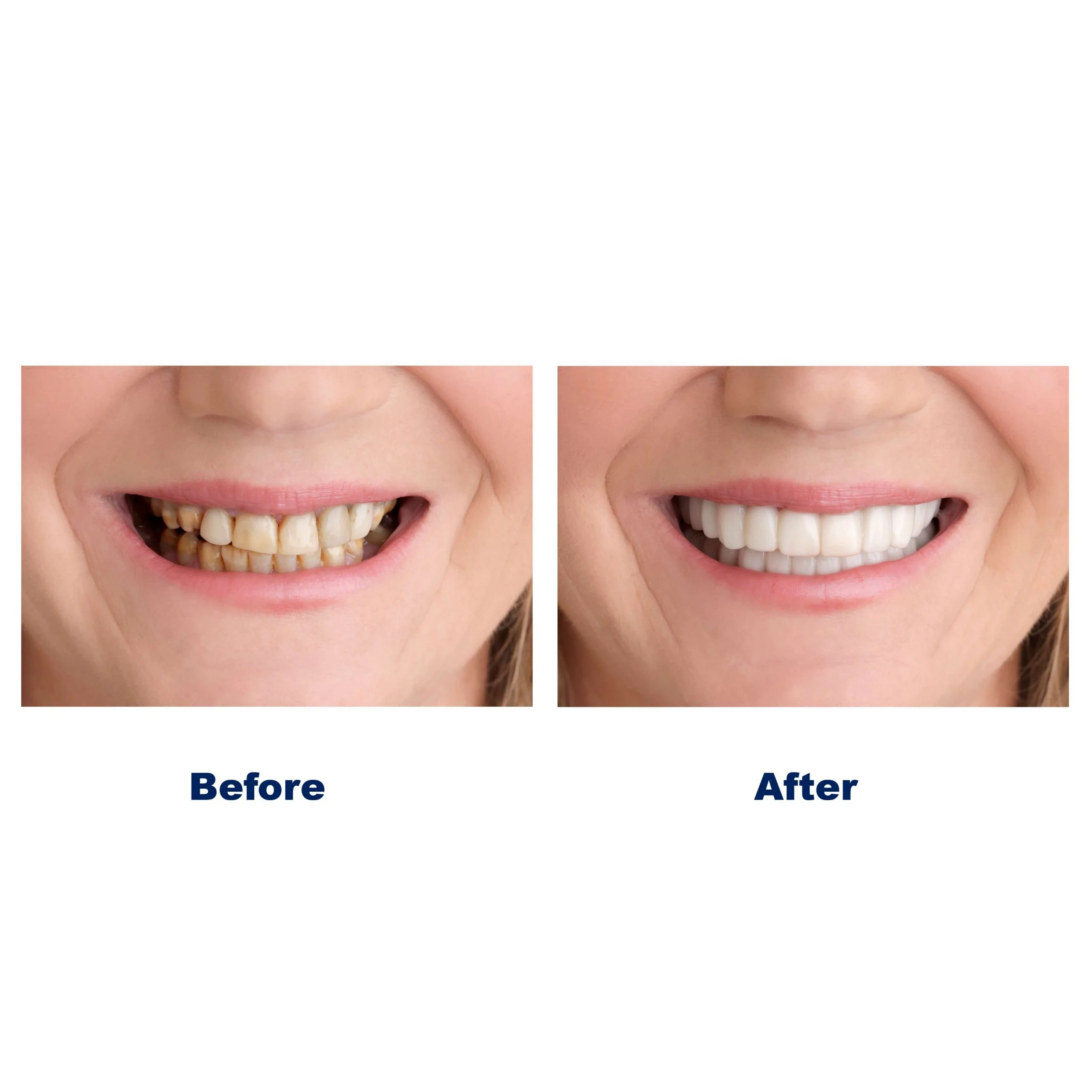 Artificial Teeth Cover Instant Teeth Veneers Portable Whiting Upper and Lower Teeth Veneers