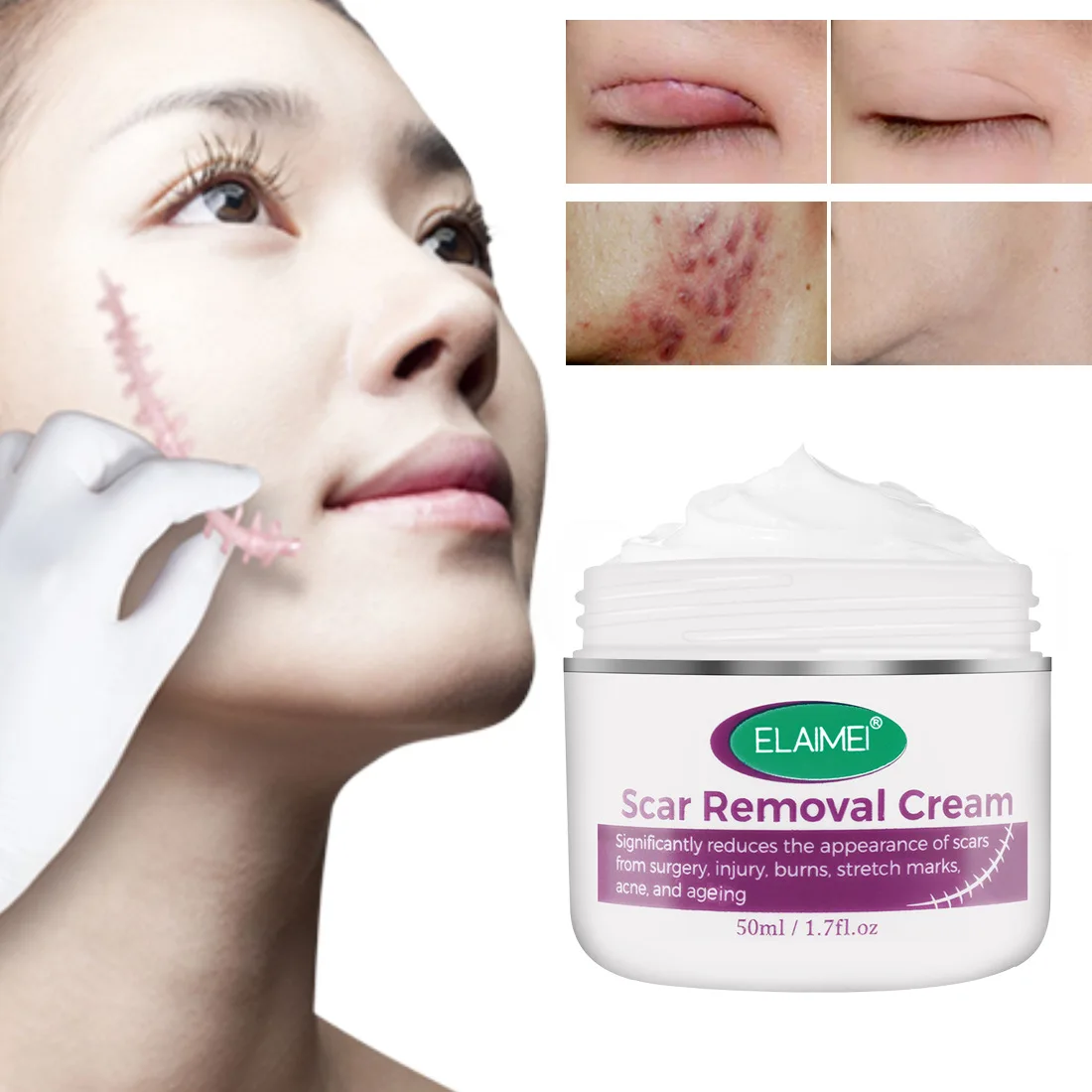 ELAIMEI Scar Removal Cream Effectively Prevents Scar Aproliferation After Surgery