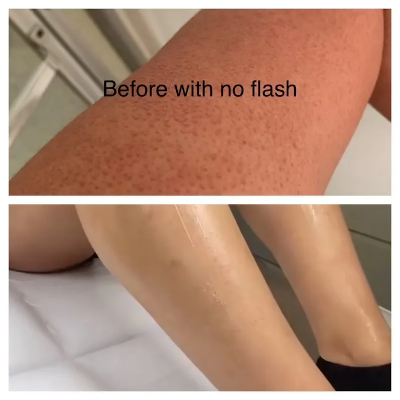 Strawberry Legs Cream Fades Strawberry Spots All Over Skin Smooth Strawberry Legs Exfoliating Cream