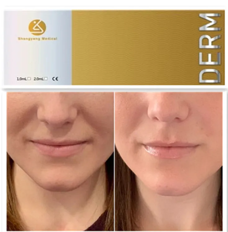 Shangyang CE  factory acide hyaluronic revolax dermal filler  injections syringes  10ml