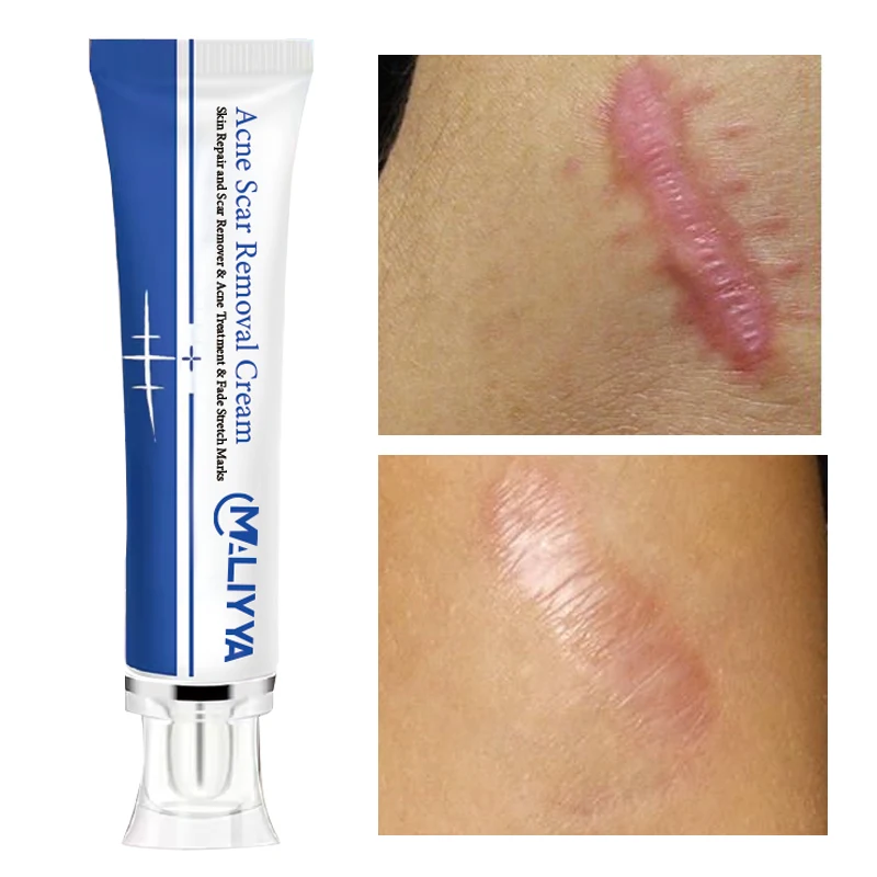 Wholesale Natural Herbal Mango Anti Scar Cream Anti Wrinkle Maternity Repair