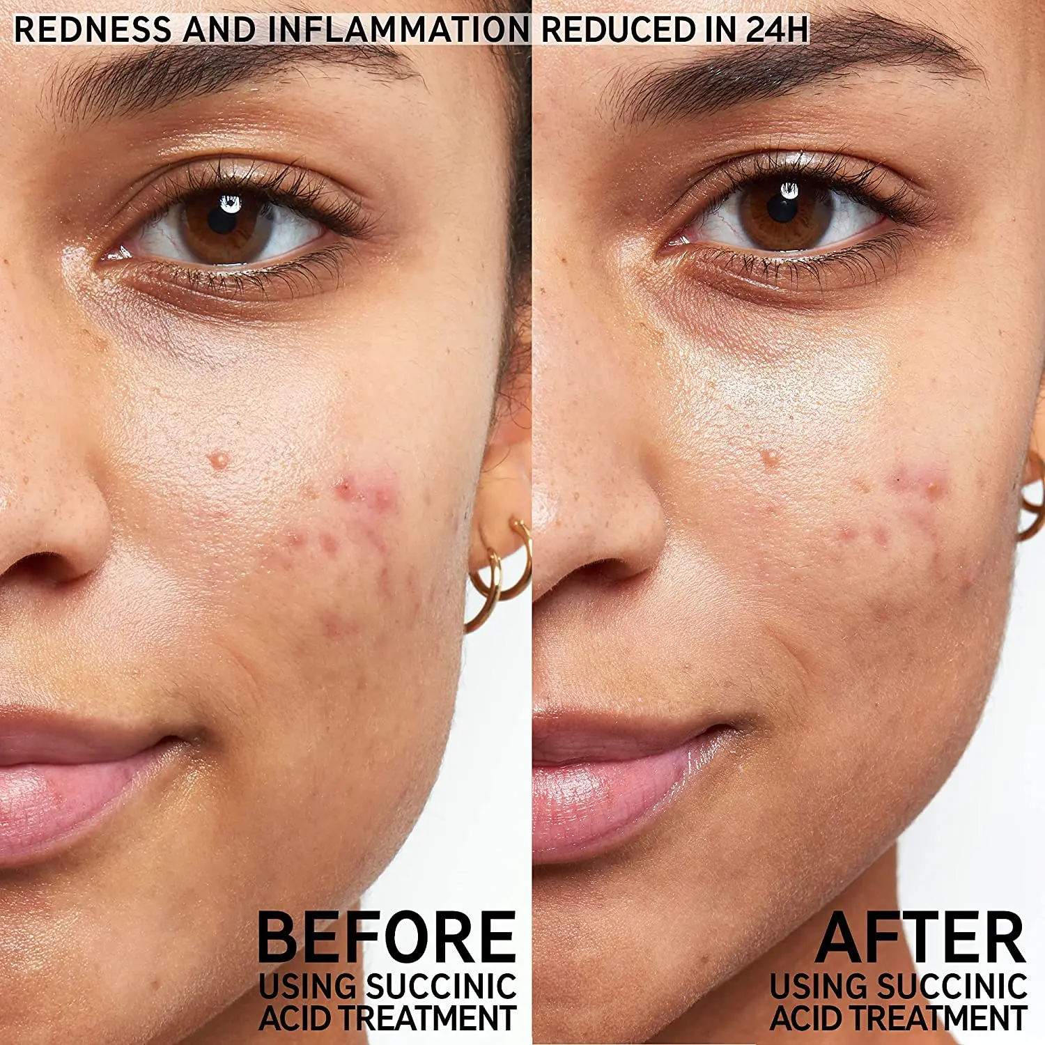 New Arrival Organic Repair Clogged Pores Succinic Acid Blemish Treatment For All Skin Types