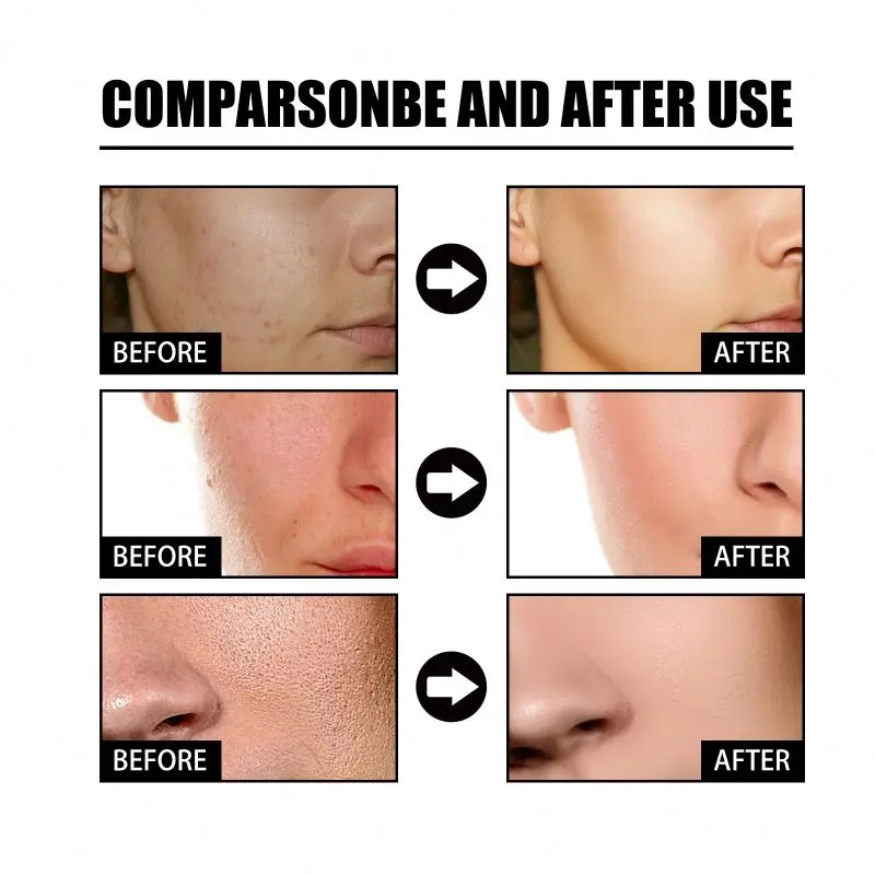 EELHOE Nicotinic Acid Facial to Weaken Acne Marks Moisturize Pores Shrink and Whiten Skin Essence