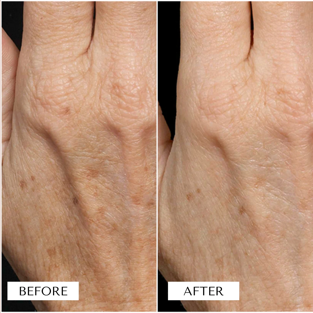 New Trend 60W Monaliza CE Approved Skin Resurfacing RF Tube Fractional CO2 Laser Vaginal Tightening Medical Aesthetic Machine