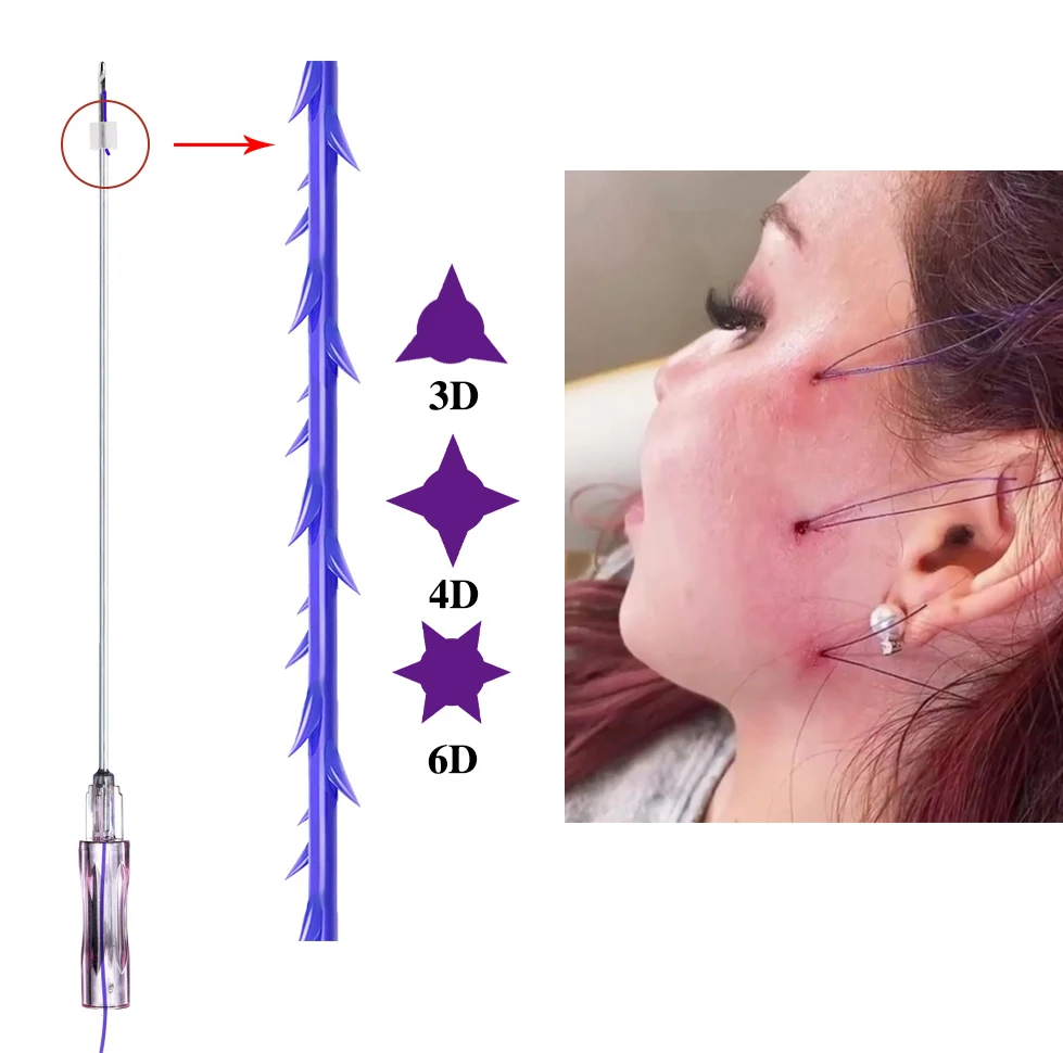 Ce Pdo Plla Pcl резьба подъемник носа моно винт Cog молдинг 4d