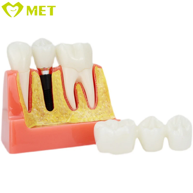Meite medical 4 Times dental implant model/dental teaching model/dental removable teeth model