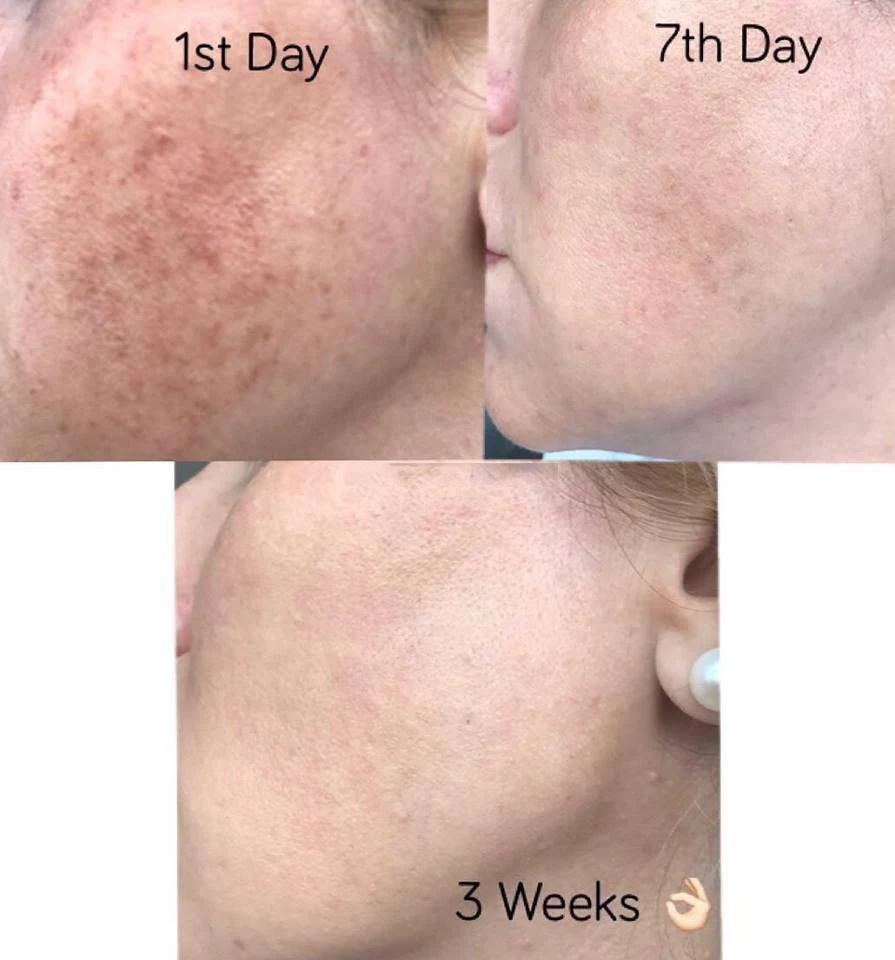 shr ipl hair removal machine price Ipl Hair Removal elight nd yag laser