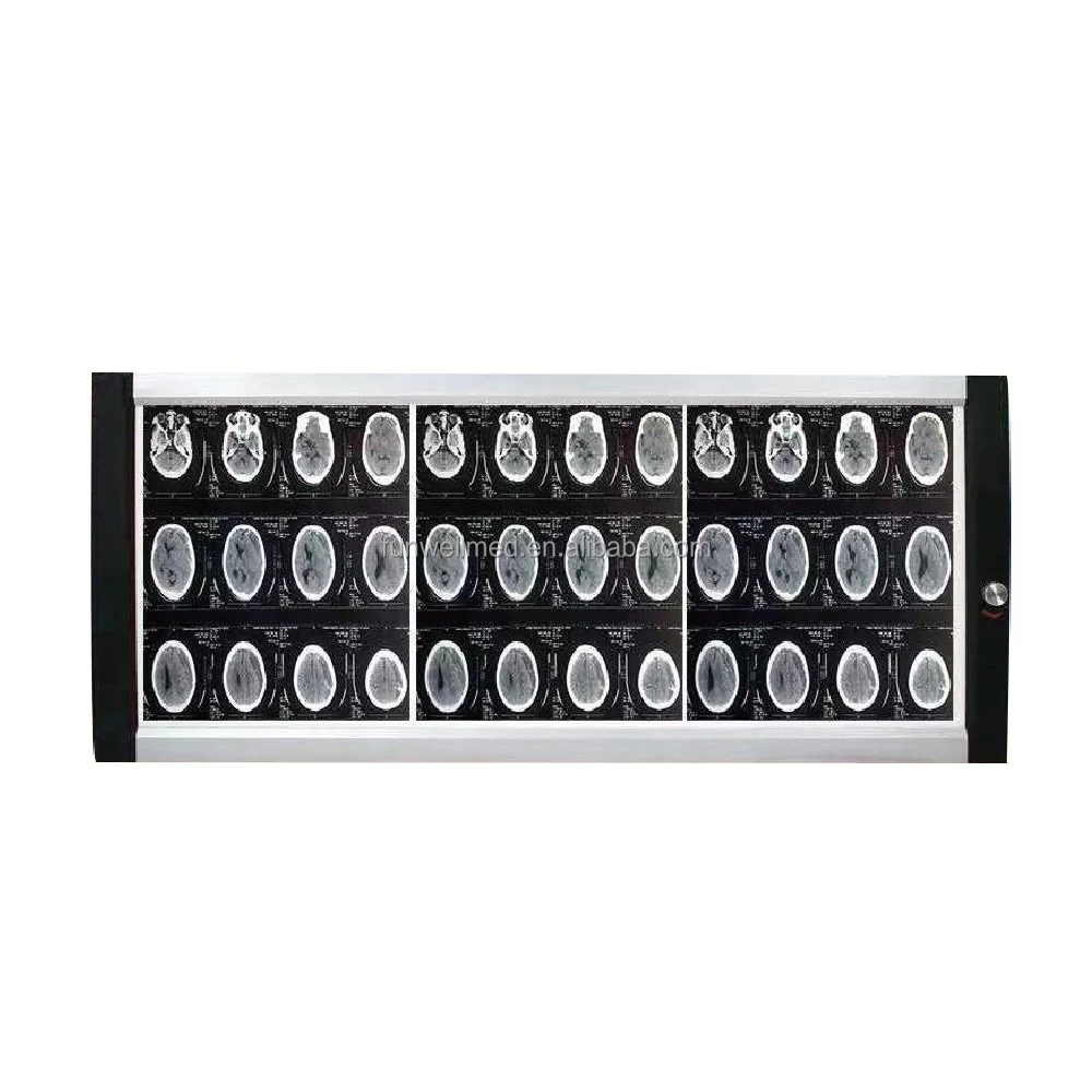 LED X Ray Negatoscope Lamp Digital CR View Box Medical Mammography X-ray Film Viewer