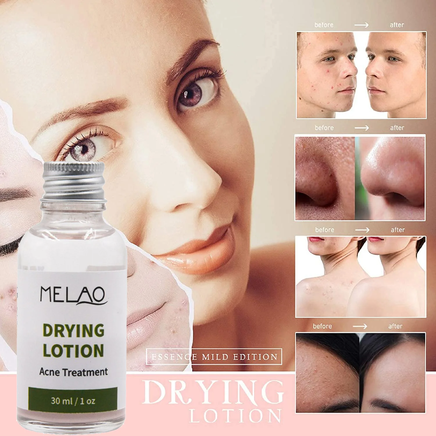 OEM/ODM High Quality Private Label Facial Care Natural Organic Acne Treatment MELAO Oil Balance Drying Lotion Acne Treatment