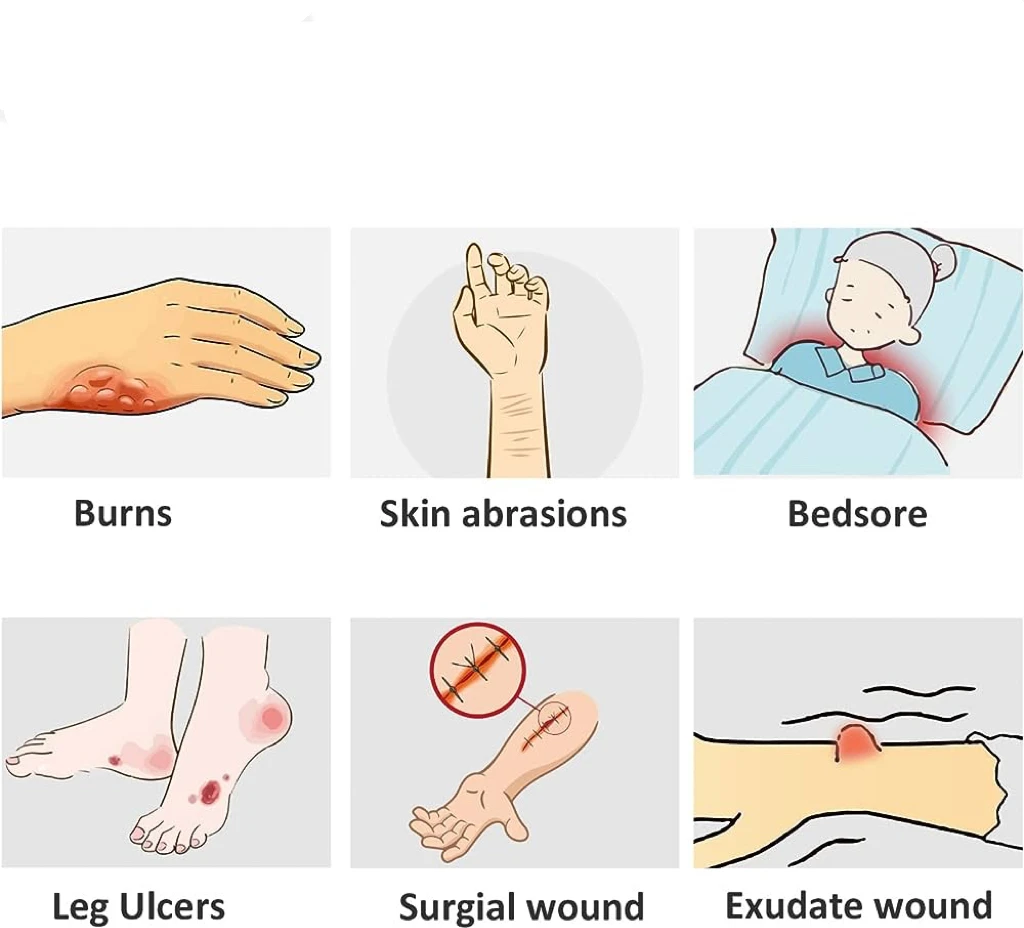 Absorbent Moist Healing Wound Care Medical High-tech Sterile  Ag Silver Alginate ION Dressing
