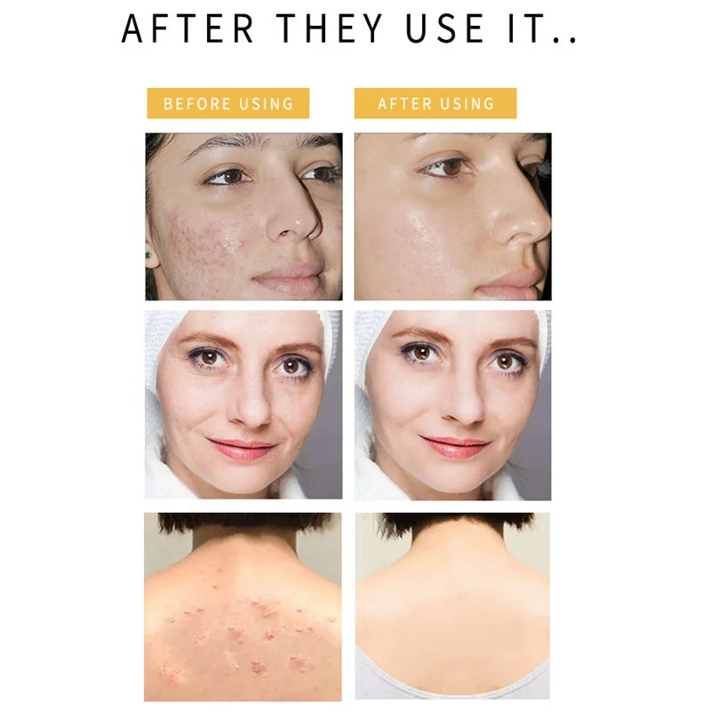 Natural Handmade Hotel Toilet Organic Whitening Soap Bar Manufacturers Anti Acne Turmeric Bath Soap Making Supplies