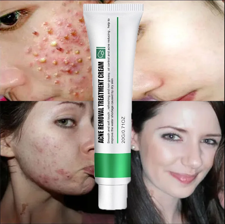 Hot selling acne and spot removal cream Lightens spots, brightens skin, moisturizes skin acne and spots skin care repair cream