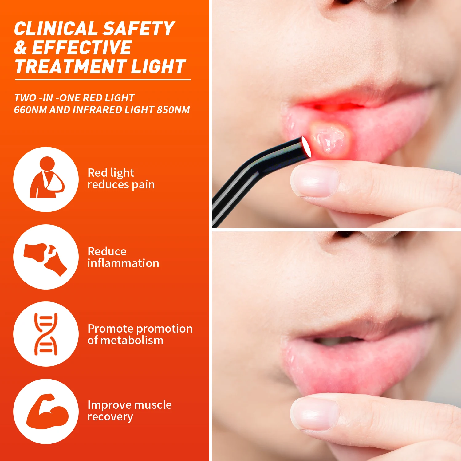 YOULUMI red light therapy cold sore 660nm 850nm infrared red light therapy for Lip herpes and acne at home