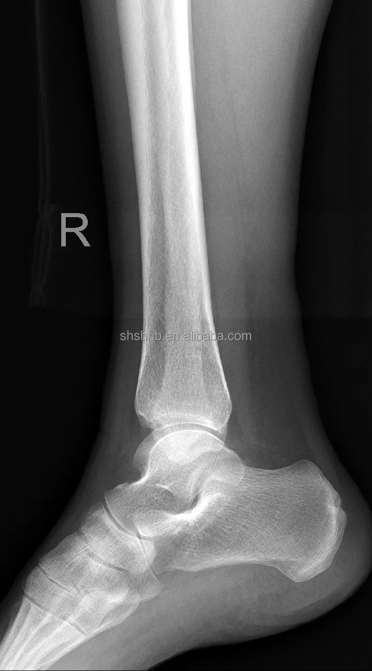 17*17 DR wired flat panel detector Medical multifunction Digital Radiography X-ray flat panel detector