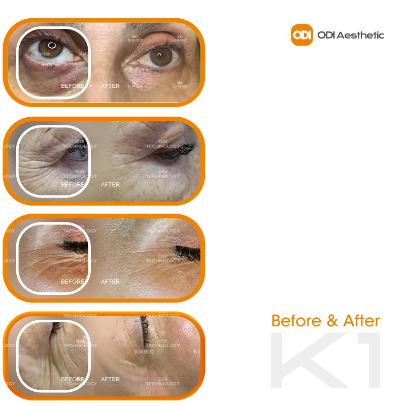 Kisseyes portable rf eye wrinkle care feature eye beauty equipment