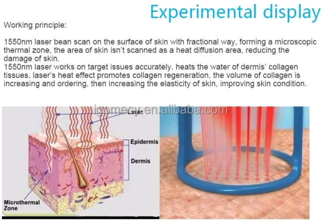  Er-Yag-laser-erbium-glass-fractional-laser/ 1550nm -erbium-glass-fiber-laser-stretch-mark-treatment  1550nm-fiber-erbium-glass-laser acne-treatment-machine 1550nm-erbium-glass-fiber-laser