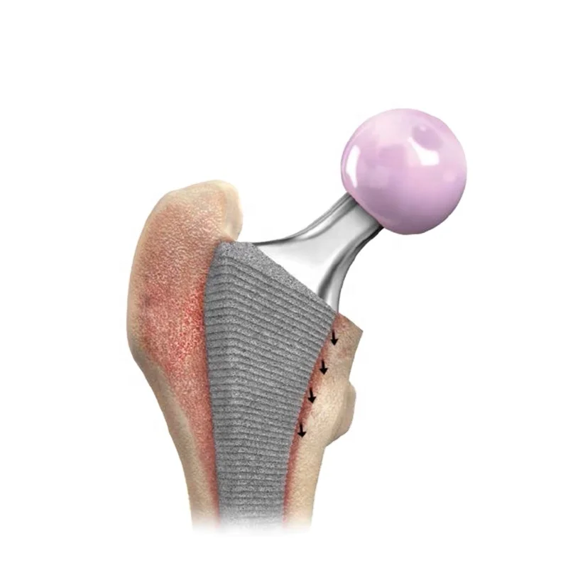 
Manufacture of titanium hip prosthesis femoral stem for total hip replacement 