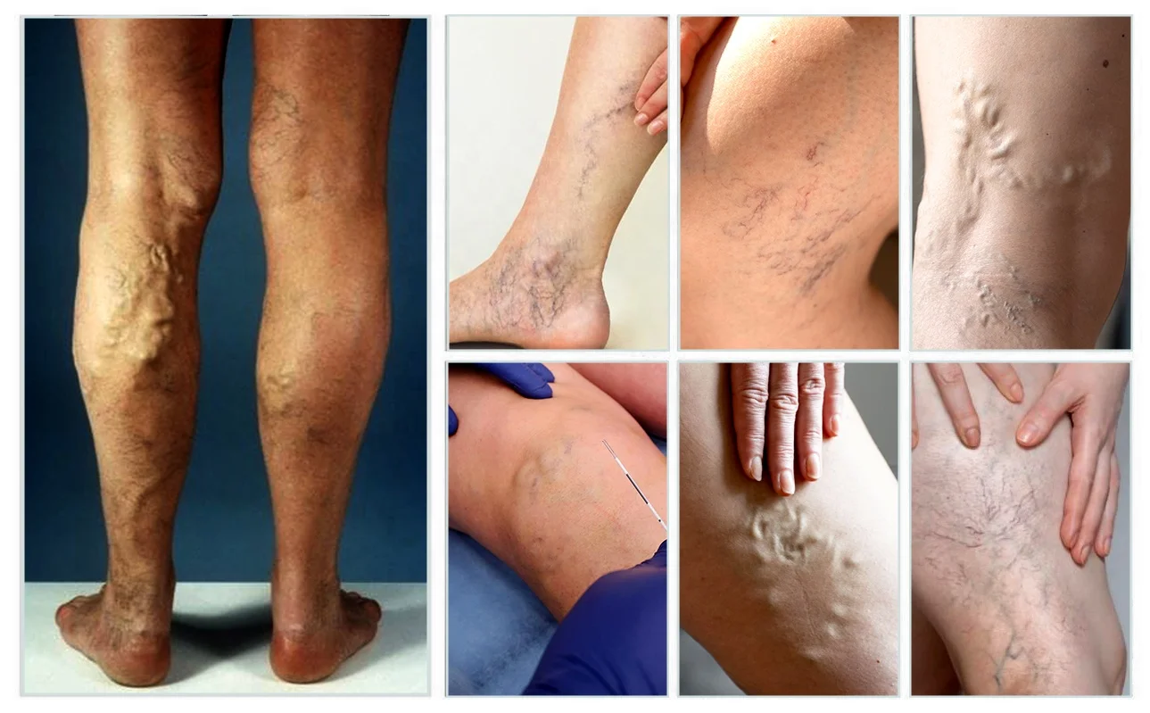 980nm high-power laser diode 1470nm laser evlt 10w fiber coupled diode laser cw spider vein removal