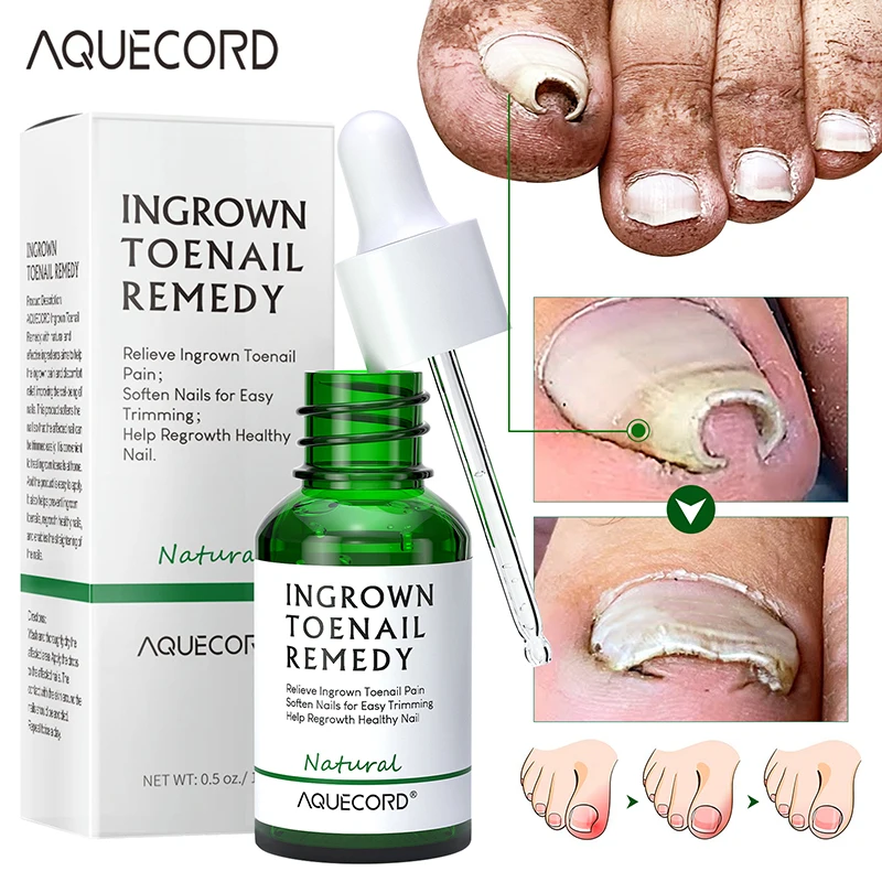 Private Label Nail Treatment Oil Anti Infection Paronychia Onychomycosis Feet Care Nail Fungus Removal Gel Care