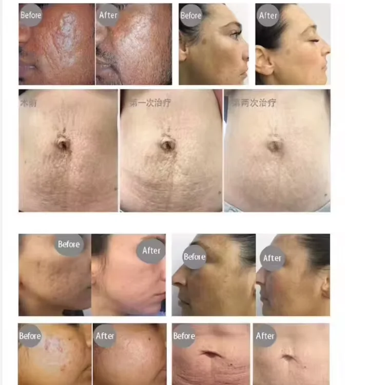 2 In 1 Multifunction Skin Rejuvenation And Firming Stretch Mark Removal Beauty Machine Large Pores Scars Skin Coarseness