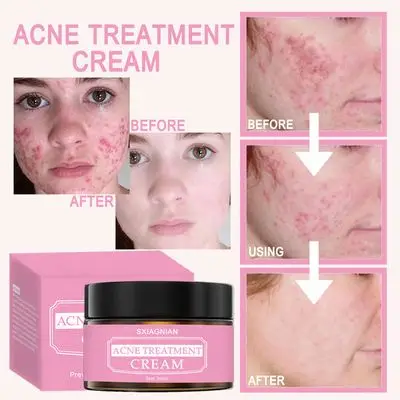 SXIAGNIAN  Natural Fast Effective High Quality Benzoyl Peroxide 10% Anti Acne Face Cream