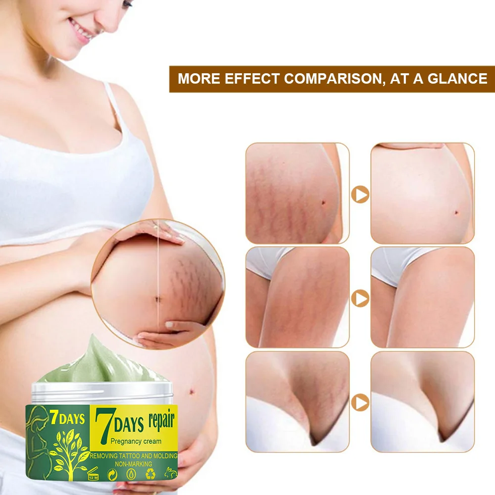 Natural Mild Non-irritating Remove Stretch Mark Cream for Pregnancy Repair Scar Slack Line Abdomen Stretch Marks Cream