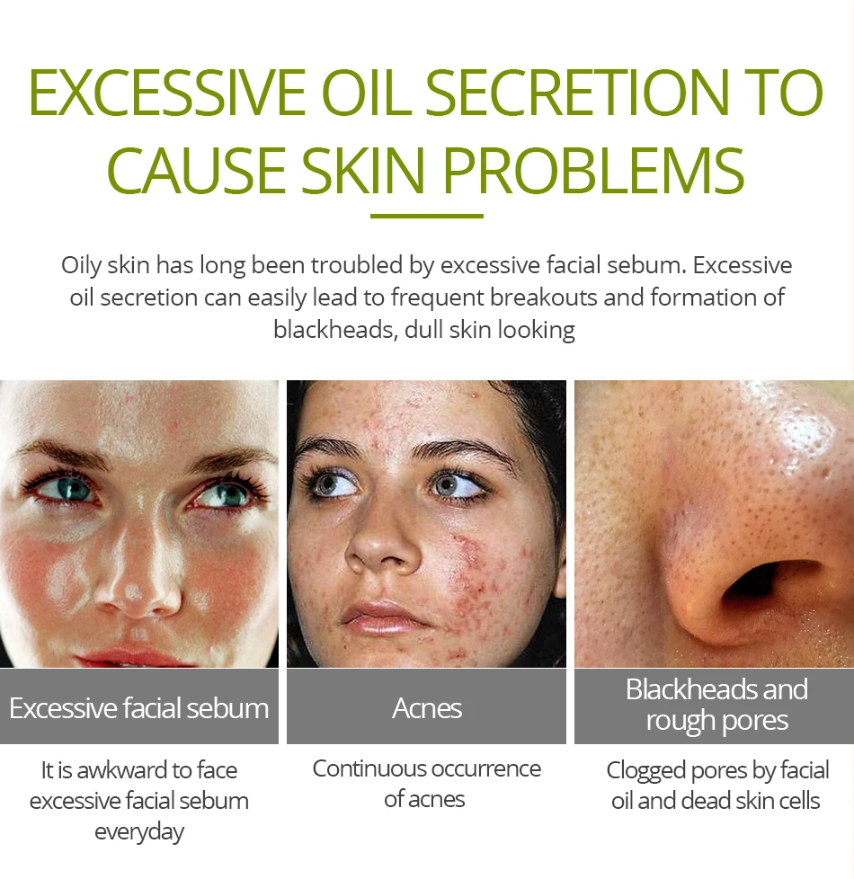 VIBRANT GLAMOUR Tea Tree Anti-Acne Face Cream Oil Control Shrink Pores Acne Cream Nourish Whitening Acne Scar Remove Skin Care