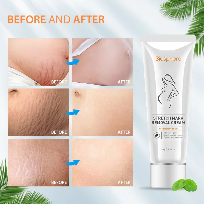 Halal anti stretch marks cream removing stretch marks treatment cream