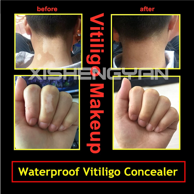 Women Men Face Discolored Skin Vitiligo Patches Makeup Vitiligo Leukoderma Covering  Waterproof Concealer Cream
