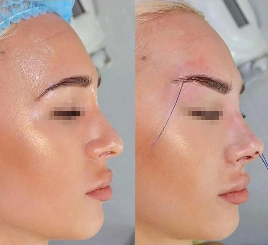 Korea lift the facial sagging soft tissue body parts pdo cog  lifting threads