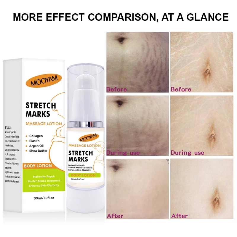 Remove Stretch Marks Cream Anti Wrinkle Beauty Whitening Skin Scar Repair Stretch Removal Marks Cream for Pregnancy