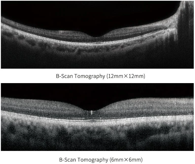 CE marked medical ophthalmology department Optical Coherence Tomography angiogrphy