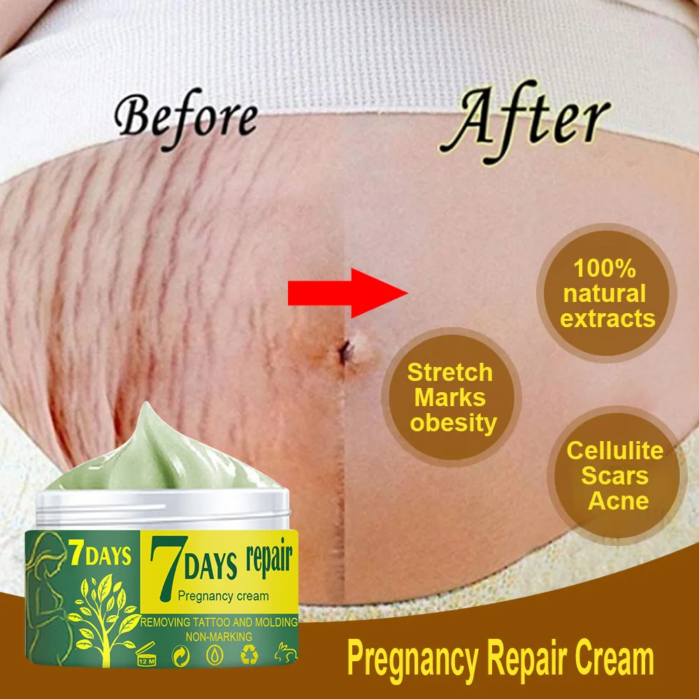 Natural Mild Non-irritating Remove Stretch Mark Cream for Pregnancy Repair Scar Slack Line Abdomen Stretch Marks Cream