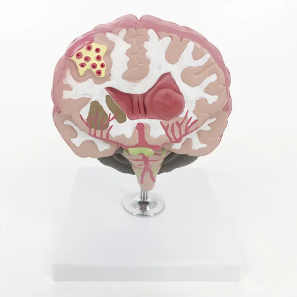BMN/N051 Brain Stroke Model (Brain Disease Model)