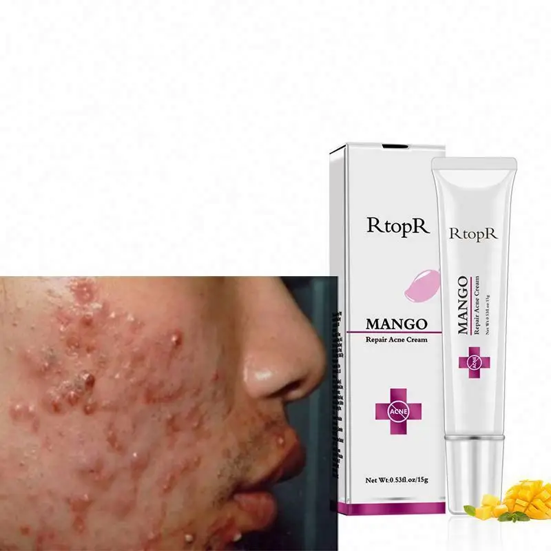 Oem оптом! Без гормонов быстрая работа 1 неделя крем для удаления шрамов частная торговая марка